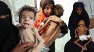 الصحة العالمية: 40 % من أطفال اليمن يعانون من سوء التغذية الحاد