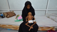 الأمم المتحدة تدعو إلى تجنب حدوث مجاعة في اليمن